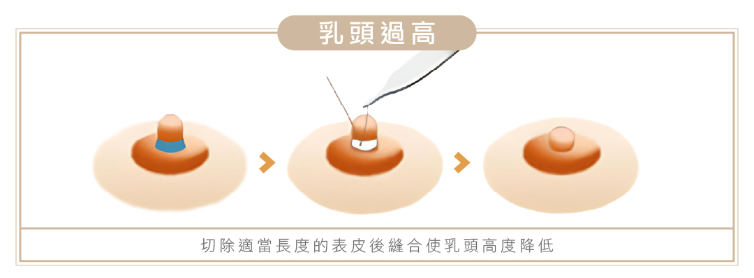 乳頭手術1 - 葛鎂診所