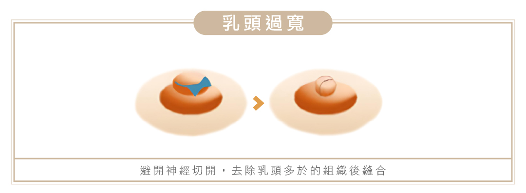 乳頭手術2 - 葛鎂診所