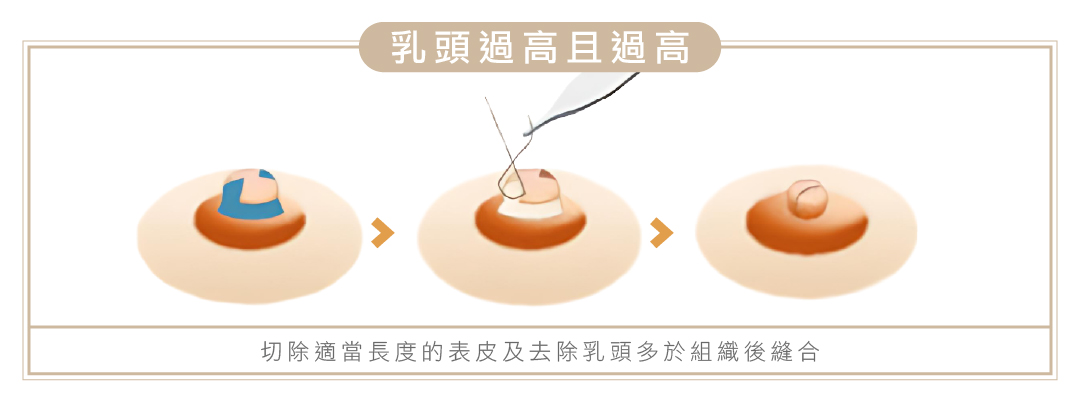 乳頭手術3 - 葛鎂診所