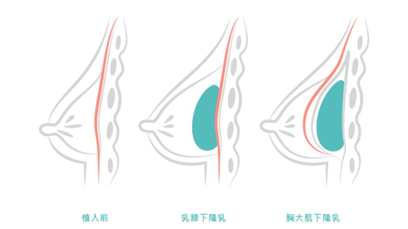 內視鏡果凍矽膠隆乳