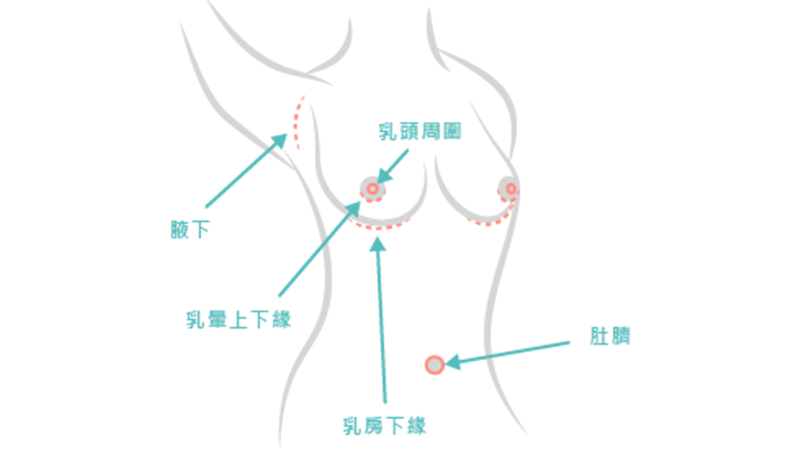 內視鏡果凍矽膠隆乳