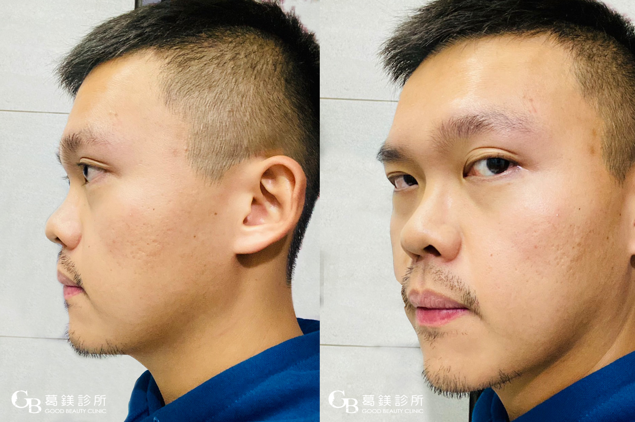 男性の鼻整形｜Braun Plastic Surgery